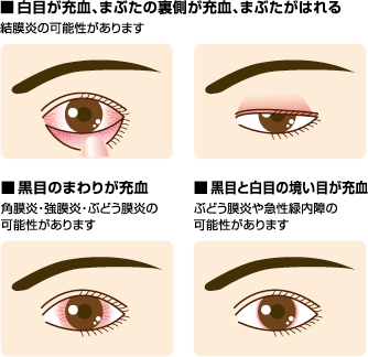 目が赤い 充血 みま眼科 港区新橋 内幸町駅1分 新橋駅3分 虎ノ門駅8分 の眼科